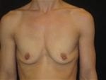 Breast Augmentation - Case Case 25 - Before