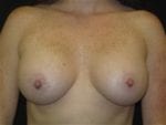 Breast Augmentation - Case Case 26 - After