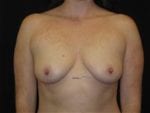 Breast Augmentation - Case Case 26 - Before