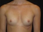Breast Augmentation - Case Case 27 - Before