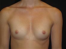Breast Augmentation Patient Photo - Case Case 27 - before view-