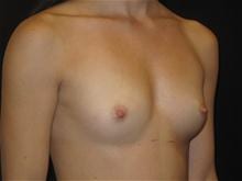 Breast Augmentation Patient Photo - Case Case 27 - before view-1