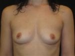 Breast Augmentation - Case Case 28 - Before