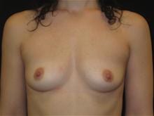 Breast Augmentation Patient Photo - Case Case 28 - before view-0