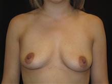 Breast Augmentation Patient Photo - Case Case 29 - before view-