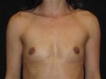 Breast Augmentation - Case Case 31 - Before