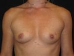 Breast Augmentation - Case Case 33 - Before