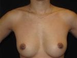 Breast Augmentation - Case Case 38 - Before