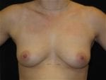Breast Augmentation - Case Case 40 - Before