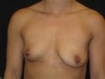 Breast Augmentation - Case Case 42 - Before