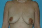 Breast Lift w/ Augmentation - Case Case 4 - Before