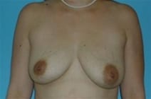 Breast Lift w/ Augmentation Patient Photo - Case Case 4 - before view-0