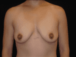 Breast Lift w/ Augmentation - Case Case 5 - Before