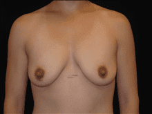 Breast Lift w/ Augmentation Patient Photo - Case Case 5 - before view-