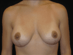 Breast Lift w/ Augmentation - Case Case 5 - After