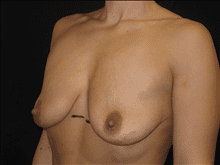 Breast Lift w/ Augmentation Patient Photo - Case Case 6 - before view-1
