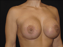 Breast Lift w/ Augmentation Patient Photo - Case Case 6 - after view-2