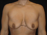 Breast Lift w/ Augmentation - Case Case 6 - Before
