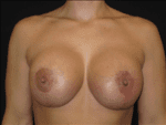 Breast Lift w/ Augmentation - Case Case 6 - After
