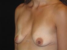 Breast Lift w/ Augmentation Patient Photo - Case Case 7 - before view-1