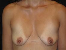 Breast Lift w/ Augmentation Patient Photo - Case Case 7 - before view-0