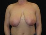 Breast Reduction - Case Case 8 - Before