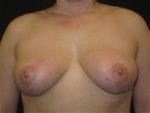 Breast Reduction - Case Case 8 - After