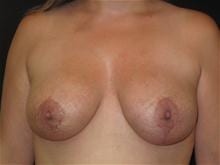 Breast Lift w/ Augmentation Patient Photo - Case Case 10 - after view-0
