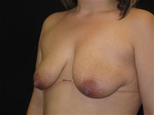 Breast Lift w/ Augmentation Patient Photo - Case Case 10 - before view-1