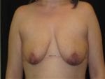 Breast Lift w/ Augmentation - Case Case 10 - Before