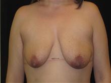 Breast Lift w/ Augmentation Patient Photo - Case Case 10 - before view-0