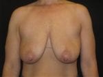 Breast Lift without Implants - Case Case 1 - Before