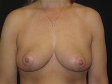 Breast Lift without Implants Patient Photo - Case Case 1 - after view