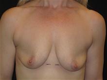 Breast Lift w/ Augmentation Patient Photo - Case Case 12 - before view-