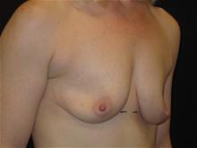 Breast Lift w/ Augmentation Patient Photo - Case Case 12 - before view-1