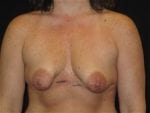 Breast Lift w/ Augmentation - Case Case 13 - Before