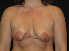 Breast Lift w/ Augmentation Patient Photo - Case Case 13 - before view-0