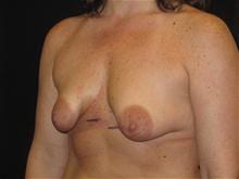 Breast Lift w/ Augmentation Patient Photo - Case Case 13 - before view-1