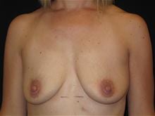 Breast Lift w/ Augmentation Patient Photo - Case Case 14 - before view-