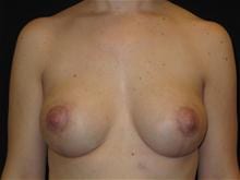 Breast Lift w/ Augmentation Patient Photo - Case Case 14 - after view
