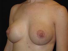 Breast Lift w/ Augmentation Patient Photo - Case Case 14 - after view-1