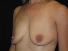 Breast Lift w/ Augmentation Patient Photo - Case Case 14 - before view-1