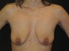 Breast Lift w/ Augmentation Patient Photo - Case Case 15 - before view-