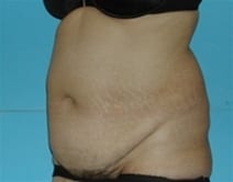 Tummy Tuck Patient Photo - Case Case 1 - before view-1