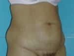 Tummy Tuck - Case Case 2 - After