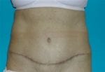 Tummy Tuck - Case Case 3 - After