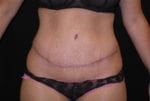 Tummy Tuck - Case Case 4 - After