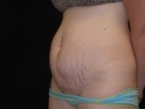 Tummy Tuck Patient Photo - Case Case 5 - before view-1