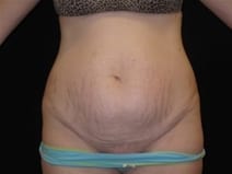 Tummy Tuck Patient Photo - Case Case 5 - before view-