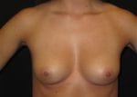Breast Augmentation - Case Case 2 - Before